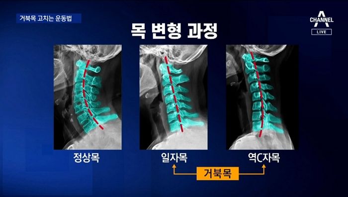 병원 갈 필요 없이 집에서 3초만에 할 수 있는 ‘거북목’ 셀프 진단법