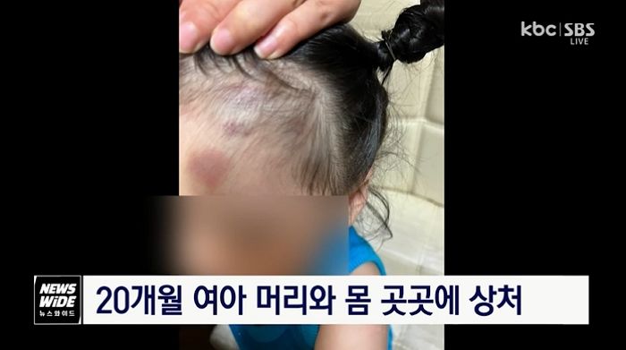 여수서 어린이집 교사 2명이 생후 20개월 여아 폭행...“내 딸 이마에 멍”