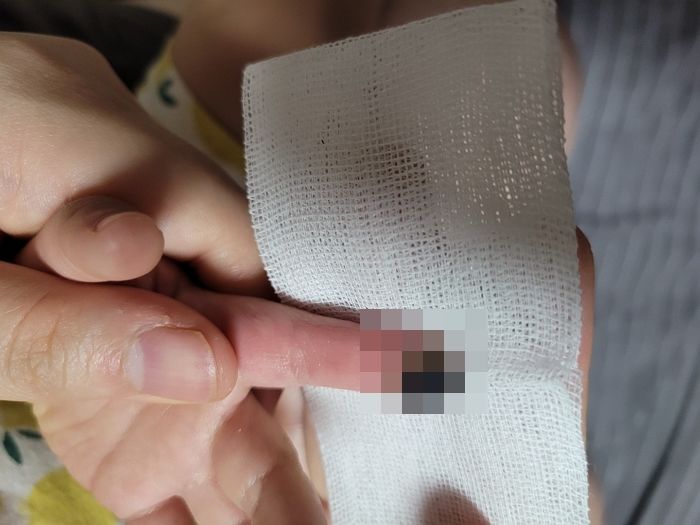 유모차에 손가락 끼어 ‘절단 사고’ 당한 2살 아기 엄마에게 유모차 회사가 보내온 공문