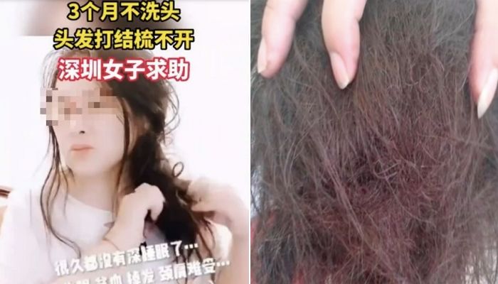 탈모에 효과 좋다는 말에 ‘3개월’간 머리 안 감은 여성의 충격적인 상태