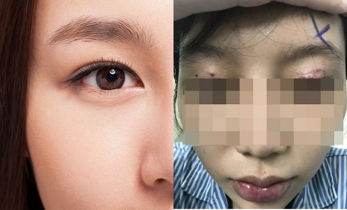 쌍꺼풀 수술 싸게 하려고 불법 시술받다가 마취주사 바늘에 수정체 뚫려 ‘실명’한 여성