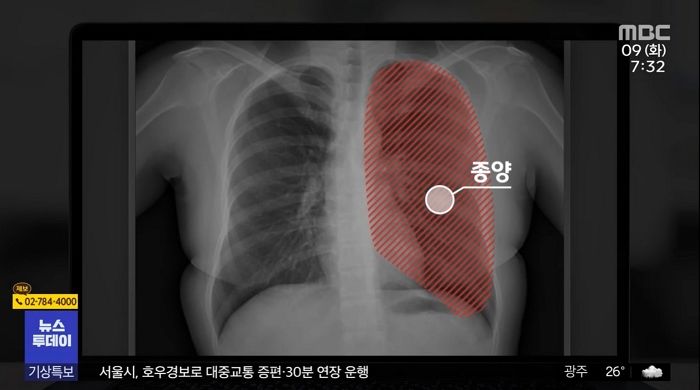 종양 있는 쪽 아닌 멀쩡한 폐 잘라 내고도 사과 한 번 하지 않은 국내 유명 병원 의사