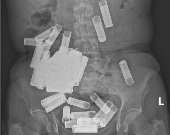 55번이나 기적적으로 죽음 피해...응급실 실려온 여성의 엑스레이에 찍힌 이물질의 정체