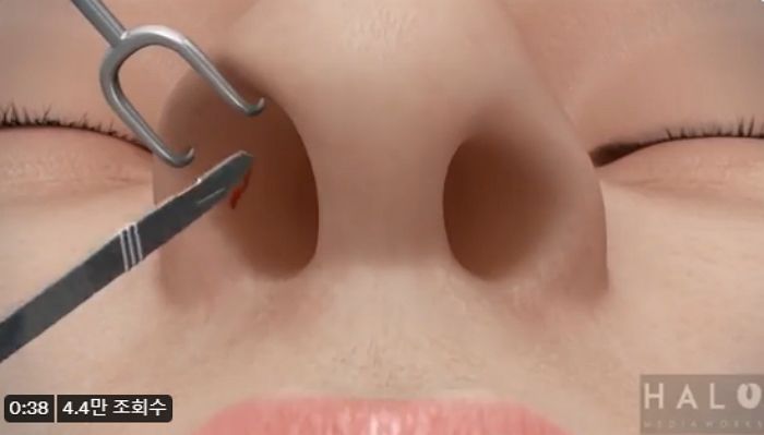 “이거 보고 코 성형하면 강심장” 수술 과정 한 눈에 보여주는 3D 영상