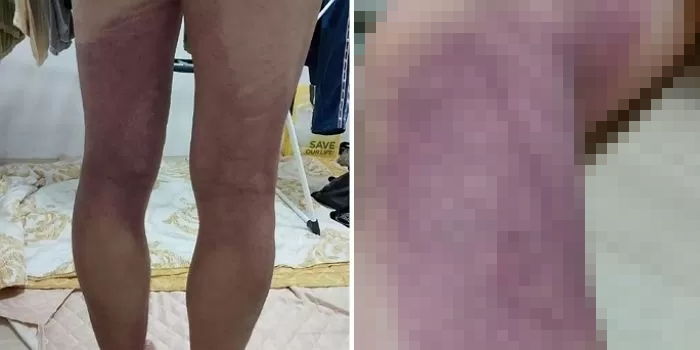 이태원 생존자 ‘피멍’에 경악한 의사의 경고 “이 증상들 있으면 당장 병원 가세요”