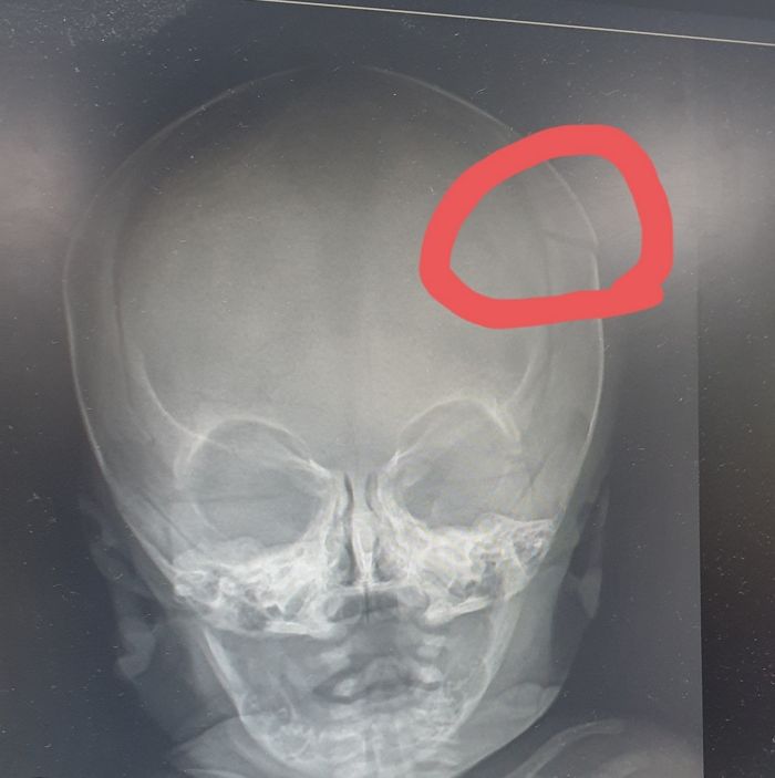 신생아 85cm 아래로 떨어져 뇌에 출혈...간호조무사 하루 동안 엄마한테 말 안했다