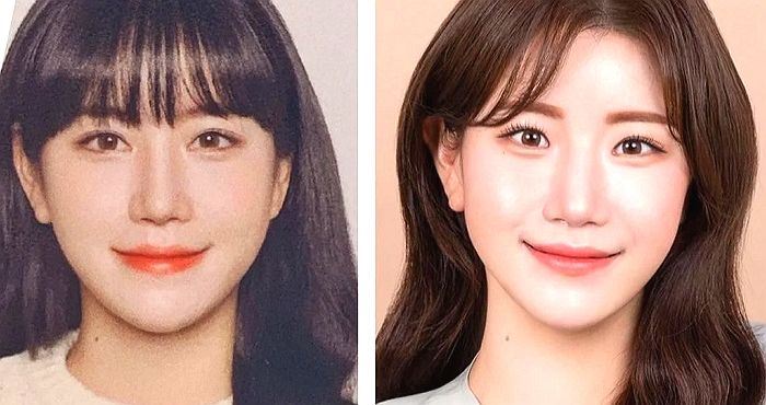 앞트임 했다가 다시 복원 수술받고 이렇게 변했습니다...어느 유튜버의 눈 수술 전후 모습