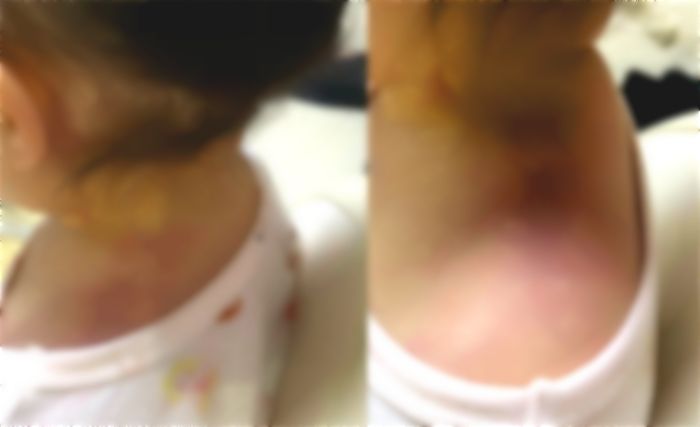 어깨에 피멍...낮잠 시간에 울었다는 이유로 두 돌 아기 어깨 10분간 짓누른 교사