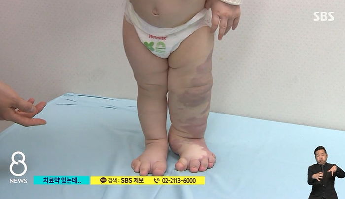 “13개월 호빈이의 코끼리 다리, 약 무료로 받을 수 있는데도 치료 못 받고 있습니다”