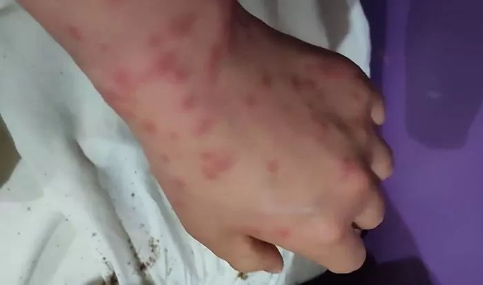 침대에 ‘진드기·빈대’ 득실한데 환불 거부한 모텔, 결국 이런 최후 맞았다