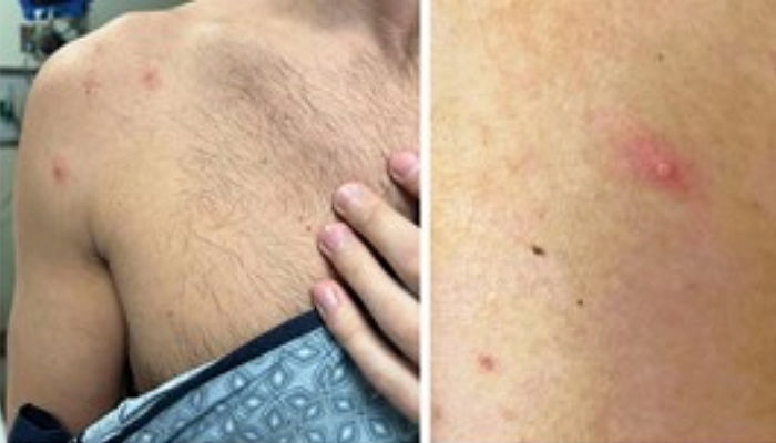 엠폭스 확진자 18명으로 늘어...대부분 환자 항문 통증 호소