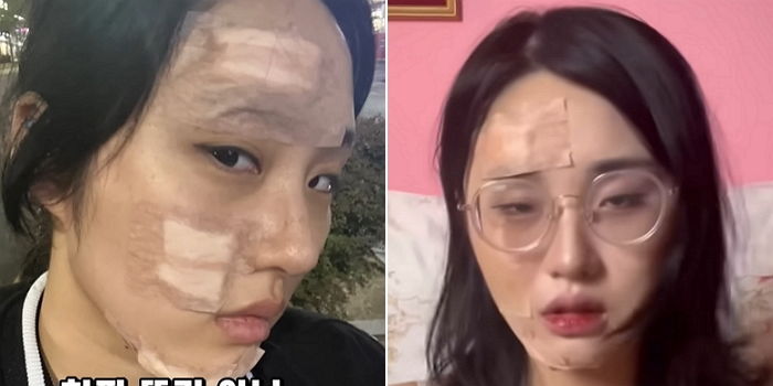 유튜버 노은솔, 교통사고로 ‘뇌진탕+얼굴 상처’ 당했다 (영상+사진)