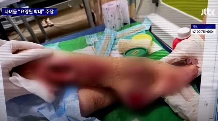 요양원 입소 3개월 만에 피부 썩어 ‘다리 절단’ 위기에 처한 80대 노인