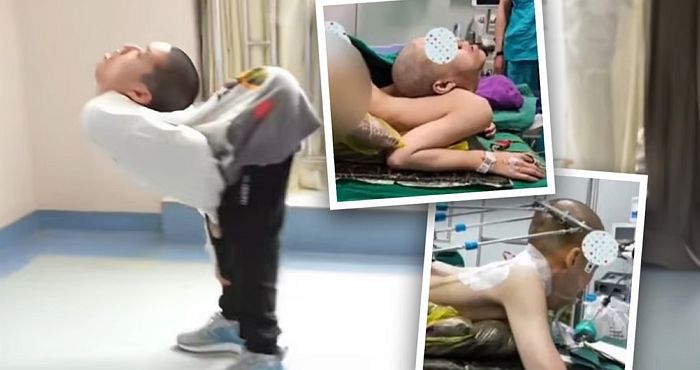 허리 구부러져 ‘폴더’라는 별명 가진 19살 소년에게 허리 펴는 수술 시켜준 의료진