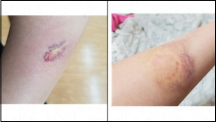 장애 학생에 폭행당해 피멍 들은 특수교사에게 “피하지 왜 맞고 있었냐” 따진 학부모들