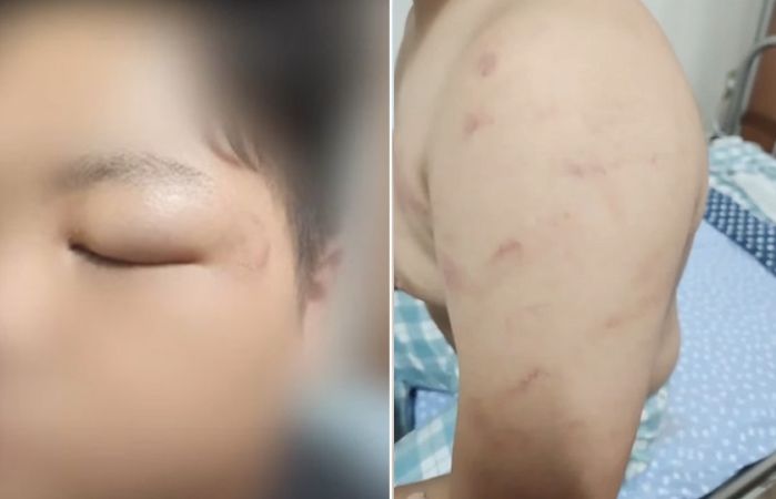 “소변 먹이고 라이터로 지져”...장애 남학생 집단 폭행한 여중생들