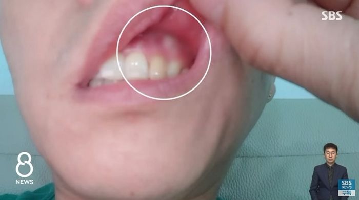 “수술 잘 됐다더니...계속 피고름 나와 짰는데 잇몸 안에 ‘썩은 거즈’가 있었습니다” (영상)