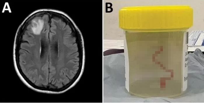 자꾸 깜빡깜빡하는 건망증 여성 뇌 사진 찍어보니...8cm 기생충이 나왔다
