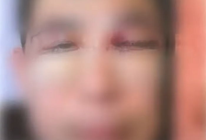 “강남 유명 성형외과서 눈 밑 지방 수술 뒤 퉁퉁 붓더니 ‘한쪽 눈 실명’ 됐습니다”