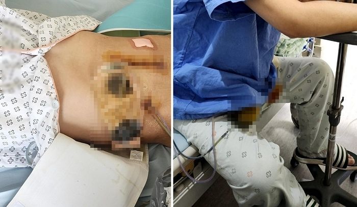 맹장수술하러 갔다가 ‘대변주머니’ 차게 만든 병원 의사가 보호자에게 한 말