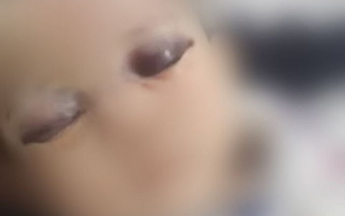 양쪽 눈 시퍼렇게 멍들 때까지 폭행당한 6개월 아기...부모·동거인은 서로 가해자 지목