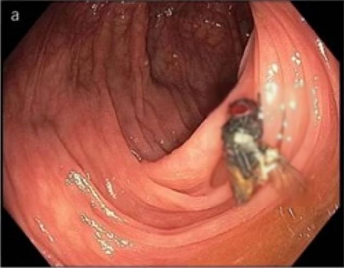 “대장 내시경 중 장 속에서 살아있는 ‘똥파리’가 발견됐습니다”