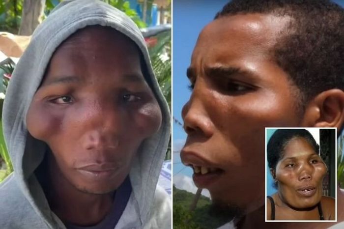 전 세계에 단 40명...얼굴뼈 변형되는 ‘E.T 병’ 걸린 5남매의 가슴 아픈 사연 (영상)