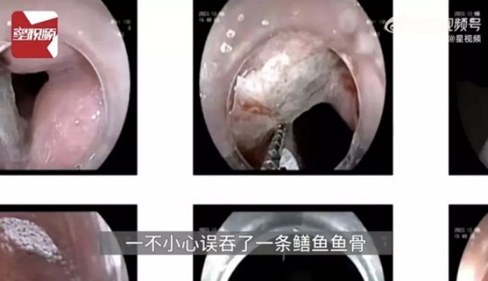 목에 ‘생선 가시’ 걸려 동맥 파열 위기 놓인 여성... ‘콘돔’으로 구한 의사들