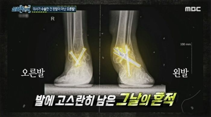왼발 아파서 병원갔는데 ‘오른발 수술’당한 남성...병원은 “언론에 알리지마” 협박했다