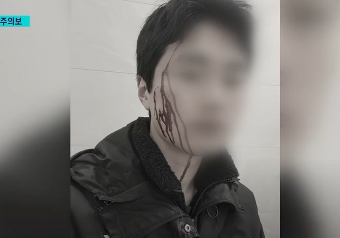 “들개에 얼굴 물려 50바늘 꿰맸다”...부산 한복판에 출몰해 사람 공격한 ‘야생 들개’