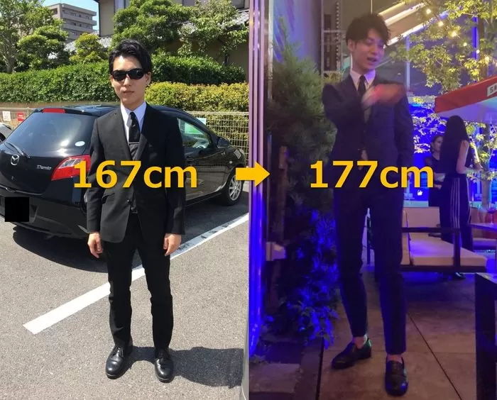 키 크는 수술로 ‘167cm→177cm’된 남성이 밝힌 5년 뒤 현재 상태