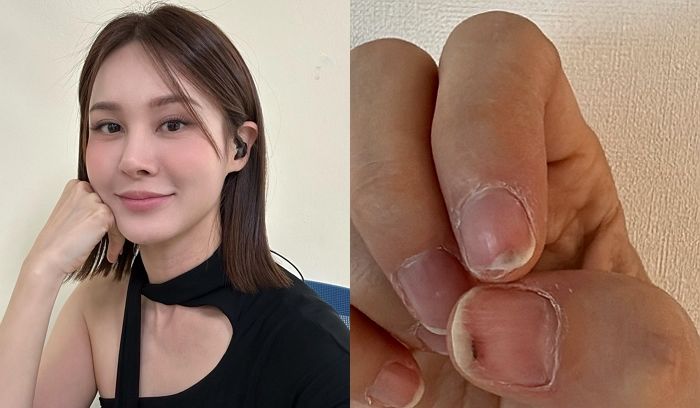 젤네일 오래 하면 이렇게 됩니다...가수 아이비가 공개한 충격적인 ‘손톱’ 상태