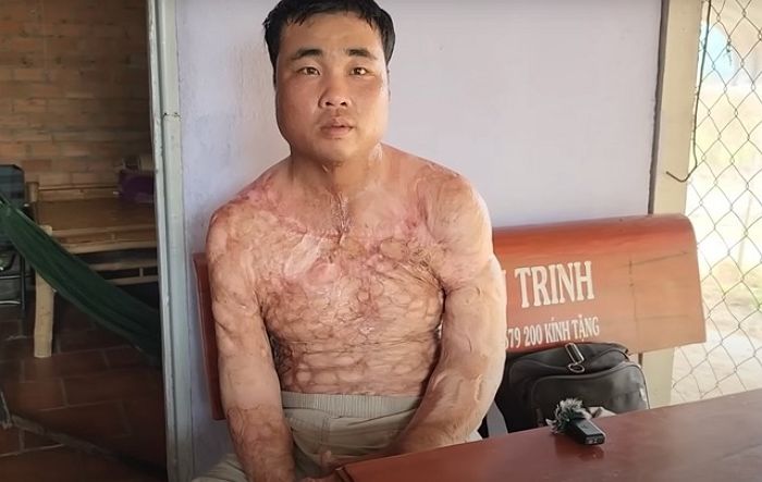 불길에 뛰어들어 ‘다리 절단’했는데도 엄마 구했다고 행복해하던 청년의 안타까운 근황