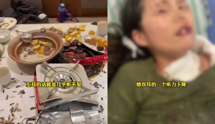 생일날 마라탕 먹으러 갔다가 부탄가스 폭발해 얼굴 전체에 화상 입은 여성