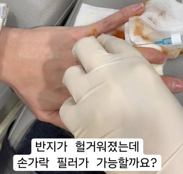 살 빠져 반지 헐거워지자 손가락에 ‘필러’ 맞은 여성