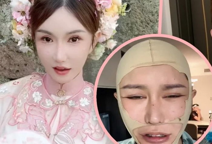2억 들여 성형했는데 눈 찌그러지고 입 비뚤어져...심각한 부작용 호소한 유명 인플루언서
