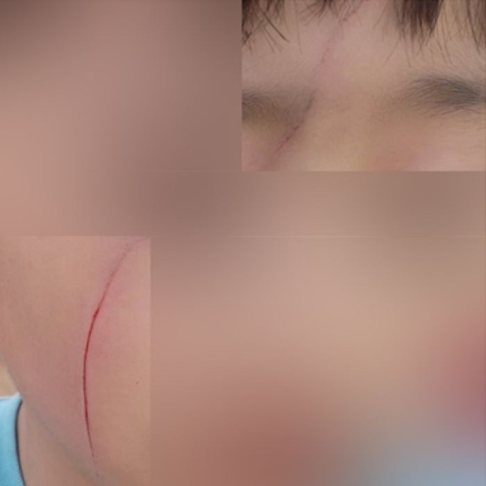 “초4 학생이 초2 아들 얼굴 연필로 그어...하마터면 눈까지 다칠 뻔했습니다”
