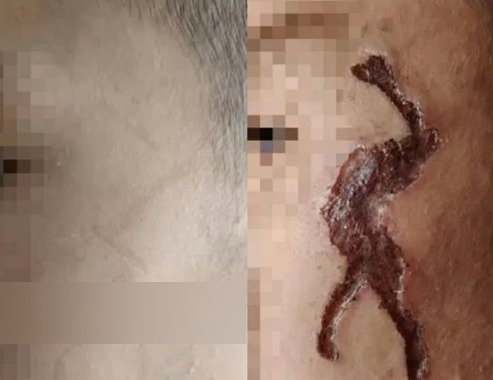 흉터 없애려고 중국 쇼핑몰서 산 ‘흉터 제거 젤’ 발랐는데... 오히려 얼굴에 ‘궤양’ 생긴 소년