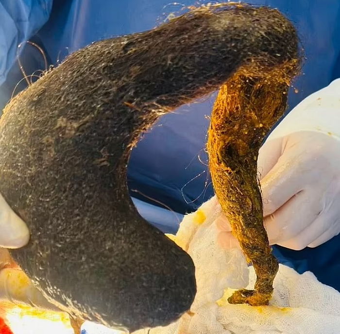 복통 호소하던 24세 여성... 뱃속에서 1kg 머리카락 덩어리 나왔다