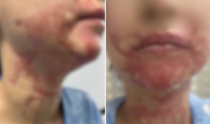 목에 두르자마자 폭발한 ‘넥 워머’... 결혼 앞둔 예비신부 얼굴에 지울 수 없는 화상 남겼다
