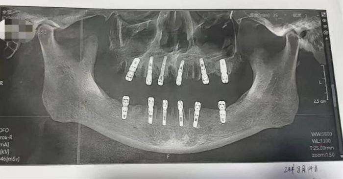 하루에 치아 23개 뽑고, 임플란트 12개 심은 남성 심장마비로 사망