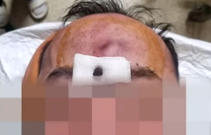 아스팔트 바닥에 넘어져 봉합 수술받은 남성... 이마에서 ‘돌’ 발견된 사연