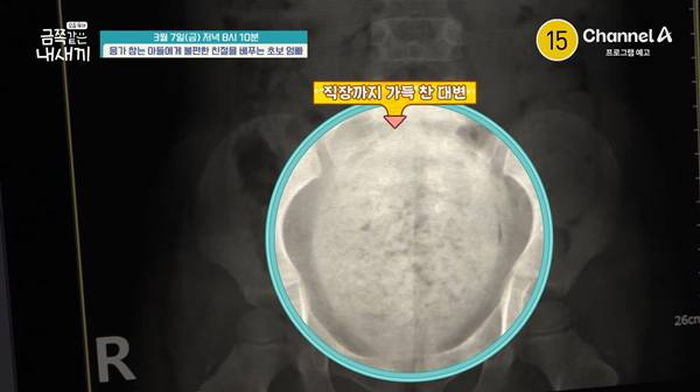 직장까지 단단한 변으로 꽉 차... 배변 거부하는 4세 금쪽이의 충격적인 건강 상태