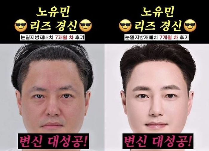노유민, 모발이식에 이어 눈 밑 ‘지방 재배치’... “요즘 민증 검사도 자주 받는다”