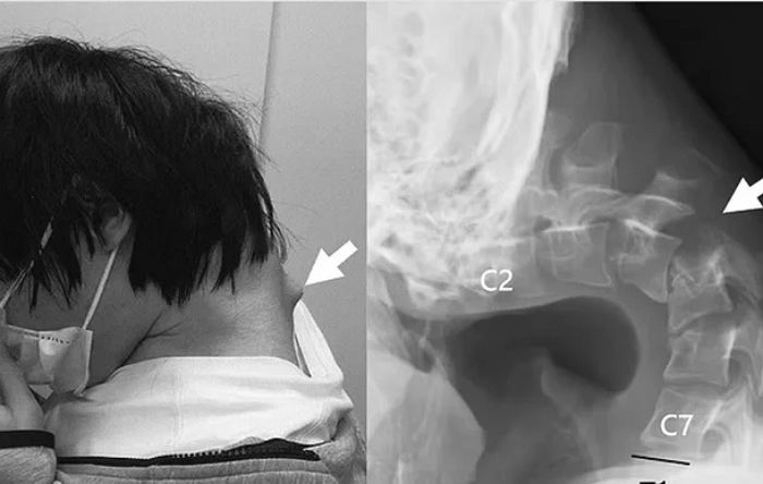 스마트폰 게임 몇 시간씩 하다 목 꺾여 버린 20대 남성의 충격적인 엑스레이 사진
