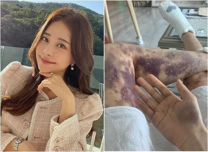 아옳이, 피부과 시술 후 전신 피멍 ‘13억 소송’ 이겼다... “허위사실 적시 아냐”
