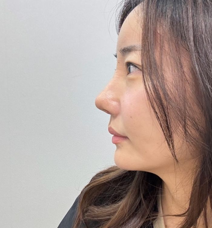 ‘조혜련 올케’ 박혜민, 코 수술 ‘대박’ 근황 전했다