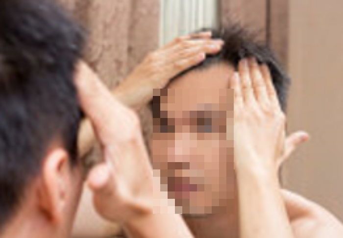 머리카락 빠진 게 성병 징후였다... “‘이런 탈모’는 매독 증상”