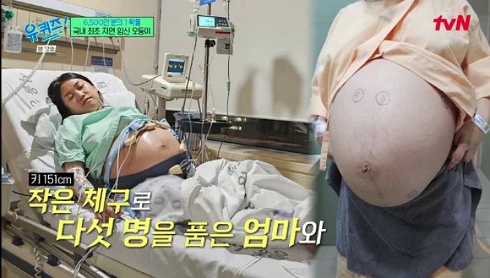 6,500만 분의 1 확률로 ‘오둥이 자연임신’ 한 여성 “선택적 유산 권유받기도”