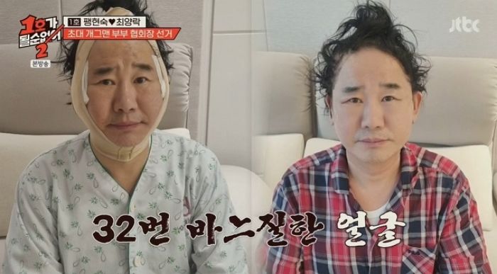 올해 63살인 최양락 ‘성형수술’ 고백... “쌍꺼풀 수술 2번에 안면거상까지 했다”